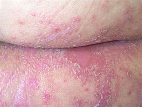 Yeast Infection on Your Skin (Cutaneous Candidiasis)