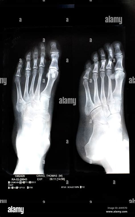 Medical "X Rays" of BRoken Bones in "Left Foot" xray "Black and Stock Photo: 2676092 - Alamy