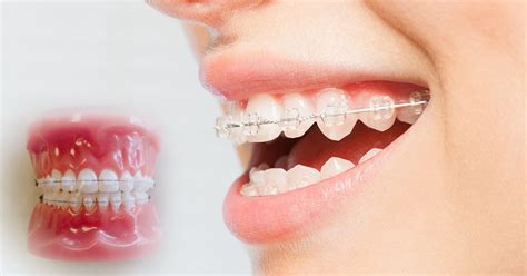 CERAMIC BRACES - vtrustdental