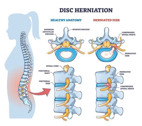 Spinal Nerves – What They Are and What They Do