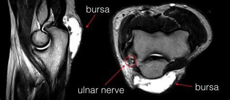 olecranon bursitis | coachingultrasound