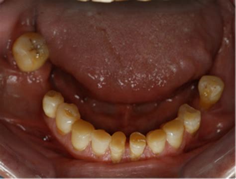 Incisal restoration of the anterior teeth and the occlusal rest seat. | Download Scientific Diagram