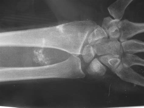 Synovial Sarcoma: Soft Tissue Sarcoma