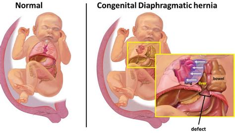 Diaphragmatic hernia causes, symptoms, diagnosis, treatment & prognosis