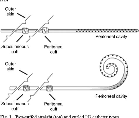 Figure 2 from Peritoneal dialysis catheter placement technique and complications | Semantic Scholar