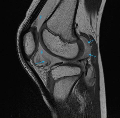 11-juvenile-chronic-arthritis-mri-knee - MRI at Melbourne Radiology Clinic