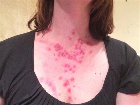 Mother-of-two who had an annoying spot on her chest in her wedding photos discovers it was skin ...