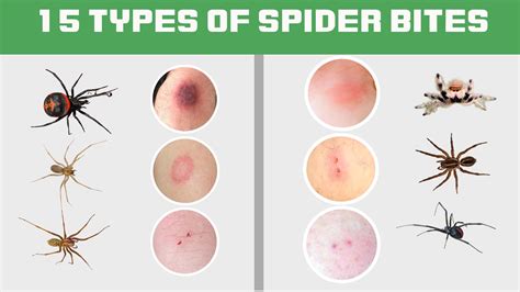 Spider Bite Identification – NBKomputer