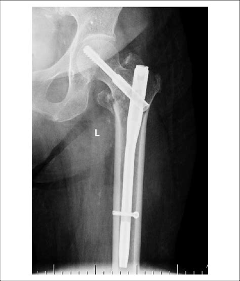 Proximal Fem Nail On X Ray - Nail Ftempo