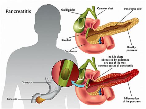 Chronic Pancreatitis - Harvard Health