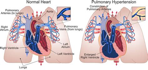 Pulmonary Hypertension - ACHA