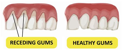 How to Prevent Gums from Receding – aulainteractiva