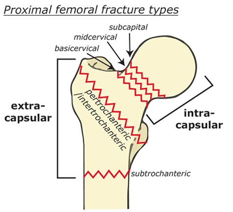 Femoral neck fracture causes, types, symptoms, diagnosis, treatment & prognosis