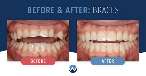 Before & After Braces: See the Amazing Results Yourself! • Woodhill Dental Specialties