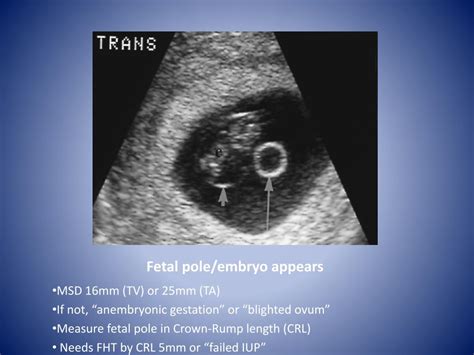 No Fetal Pole At 7 Weeks Success Stories Fetal Pole Pul Pregnancy Unknown Location Iup - ponddrawing