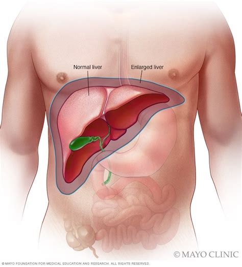 Enlarged liver - Symptoms and causes - Mayo Clinic