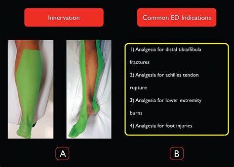 How to Perform Ultrasound-Guided Distal Sciatic Nerve Block in the Popliteal Fossa - ACEP Now