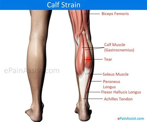 Calf Strain|Treatment|Symptoms|Recovery|Causes|Prognosis