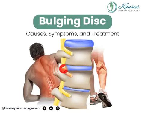 Bulging Disc: Causes, Symptoms, and Treatment