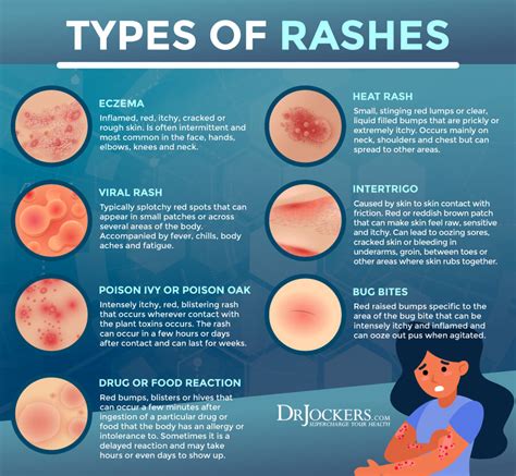 Skin rash after finishing antibiotics