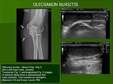 Olecranon Anatomy