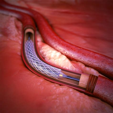 coronary artery stent 3d max