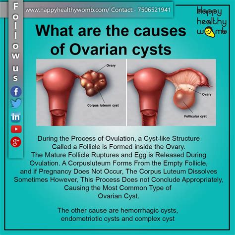 Ovarian Cust Anatomy