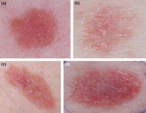 Red Dots on Skin: 19 Causes, Some Serious » Scary Symptoms