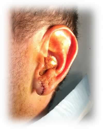 Torn and stretched ear lobe repairs - Kingsley Medical | More than your local GP