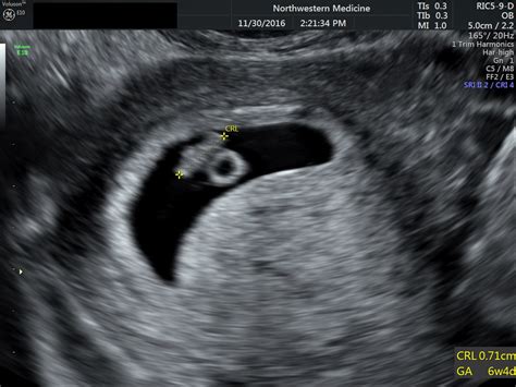 How accurate is ultrasound dating at 7 weeks | Ultrasound accuracy. 2020-04-08