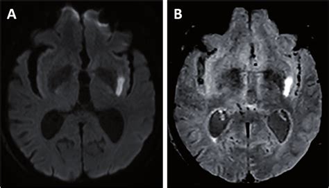 Acute ischemic stroke of the left external capsule in a 88-year-old man... | Download Scientific ...