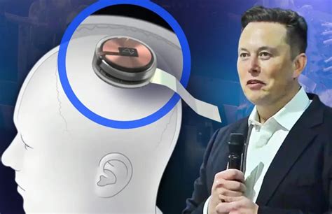 Elon Musk's Neuralink N1 FDA Approves For Human Trials, How?