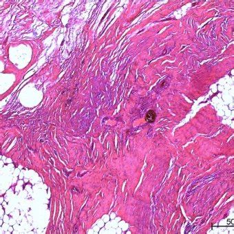 HE staining of the synovial sarcoma. The tumor is characterized by a... | Download Scientific ...