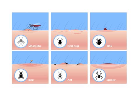 How To Identify Insect Bites A Comprehensive Guide To Recognizing Common Bug Bites – NBKomputer