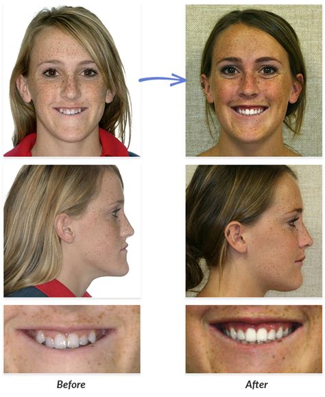 Before & After Braces Photos | DeLurgio Orthodontics : DeLurgio Orthodontics