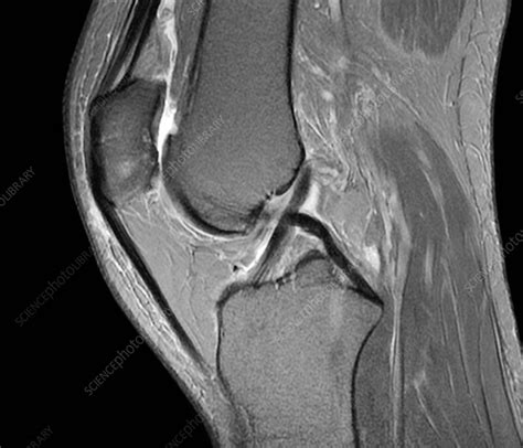 Normal knee, MRI scan - Stock Image - C026/1157 - Science Photo Library