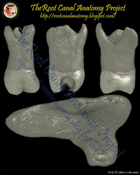 The Root Canal Anatomy Project: Taurodontism: Maxillary Second Molar