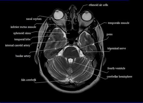 Get Anatomy Of Ct Scan Brain Background