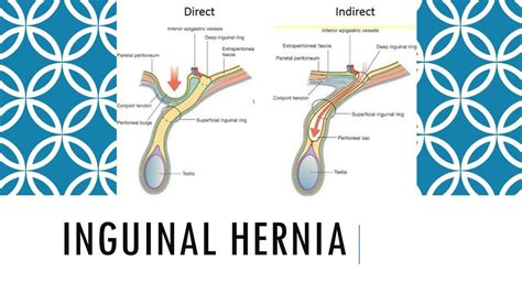 Inguinal hernia -Diagnosis and treatment