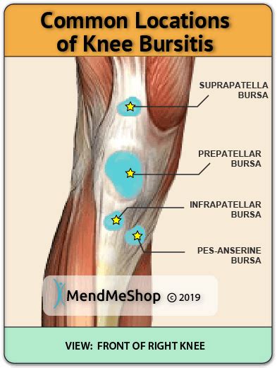 Bursitis in the Knee