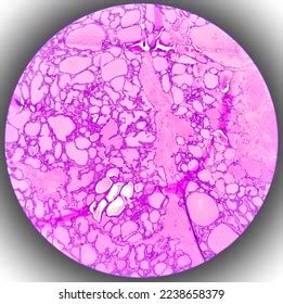 Synovial Sarcoma Histology Image Analyzed By Stock Photo 2238658379 | Shutterstock