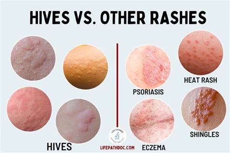 Hives (Urticaria) vs. Rash: Pictures and Differences