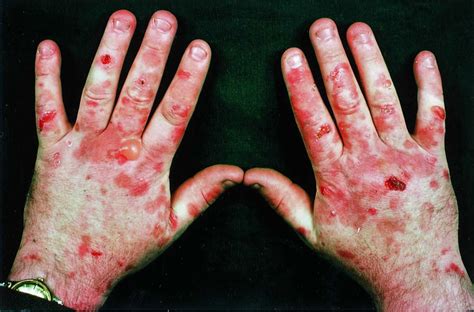 Porphyria cutaneous tarda causes, symptoms, diagnosis & treatment