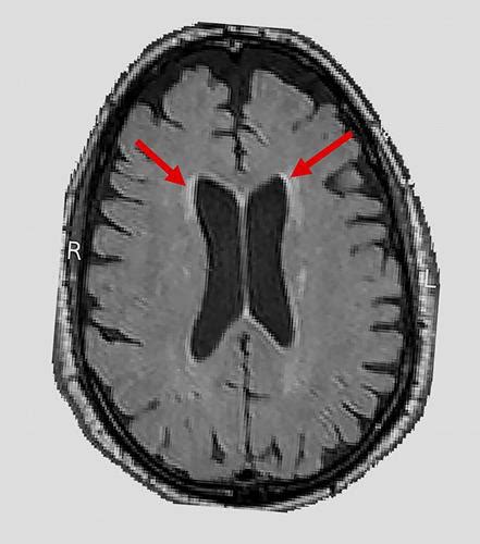 white matter disease mri Mri lesions diffuse axial - Diseases Club center