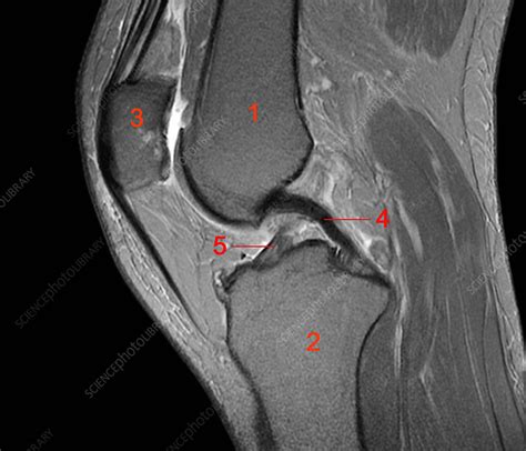 Normal knee, MRI scan - Stock Image - C026/1160 - Science Photo Library