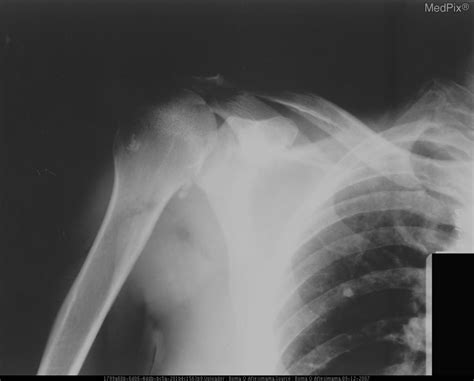 Scapula Acromion Process