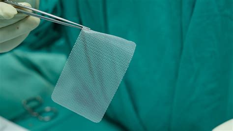 Hernia Mesh Lawsuit Settlements for Injuries | Simmons Hanly Conroy