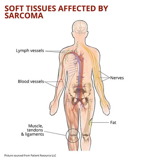 Soft Tissue Sarcoma