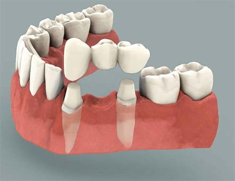 Dental Bridge - Procedure, Dental Bridge Vs Dental Implant