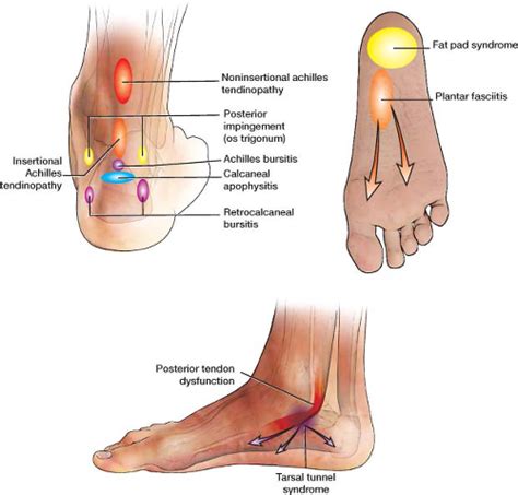 Retrocalcaneal and Achilles Bursitis | Radiology Key